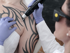 A tattoo is removed with a laser