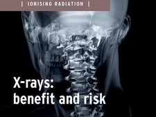X-ray: Benefit and risk