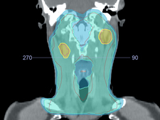 Irradiation plan of a head-neck tumour