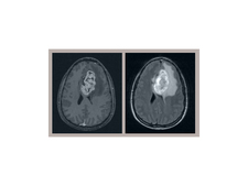 Brain with tumor