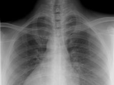 Röntgenaufnahme eines Brustkorbs
