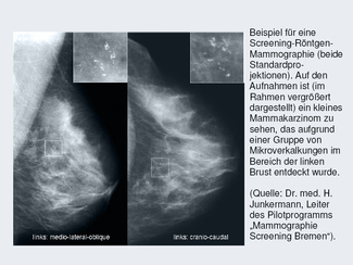 zwei Mammographie-Aufnahmen nebeneinander