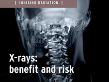 X-ray: Benefit and risk X-ray: Benefit and risk